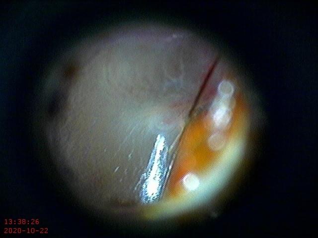 After Microsuction Ear Wax Removal